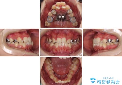 前後に重なった前歯 ワイヤー装置と急速拡大装置を併用したインビザライン矯正の治療中