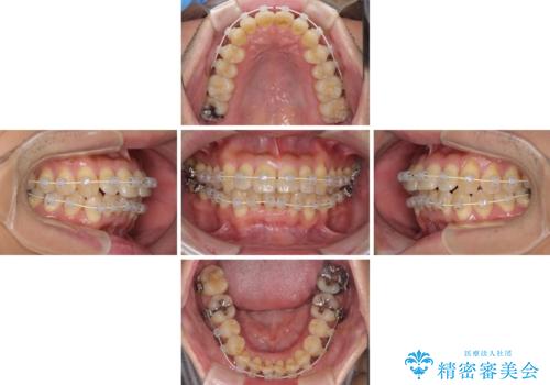前歯のデコボコ ワイヤー装置での短期間治療の治療中