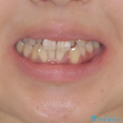 狭い上顎骨を拡大 著しい叢生を抜歯矯正で改善の治療前(顔貌)