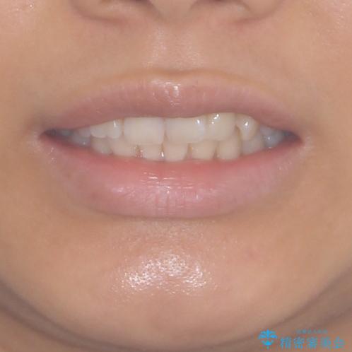 インビザラインによる矯正治療　カリエールディスタライザーを用いた奥歯の咬み合わせ改善の治療前（顔貌）
