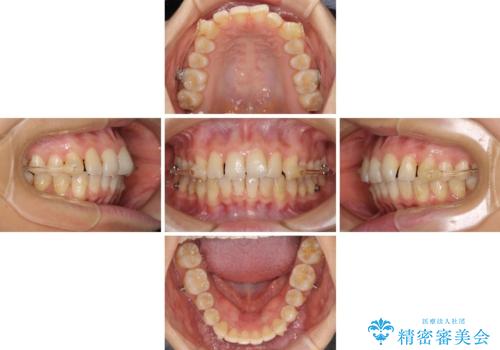 インビザラインによる矯正治療 カリエールディスタライザーを用いた奥歯の咬み合わせ改善の治療中