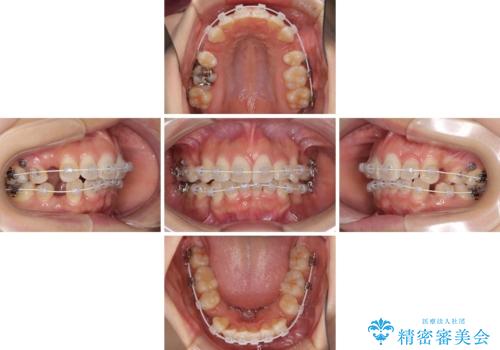 スッキリとした口元へ 出っ歯の抜歯矯正の治療中
