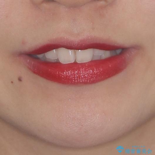 狭い上顎骨を拡大 急速拡大装置を併用したインビザライン矯正の治療前(顔貌)