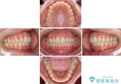 狭い上顎骨を拡大 急速拡大装置を併用したインビザライン矯正の治療中