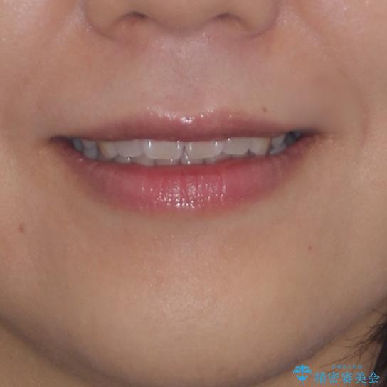 軽度な歯列不正　インビザライン・ライトによる矯正治療の治療前（顔貌）