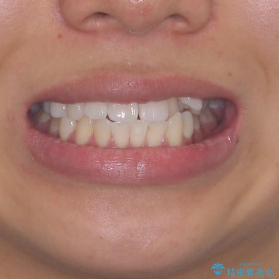 八重歯と奥歯のクロスバイト　上顎骨を拡大してインビザラインで矯正の治療前（顔貌）