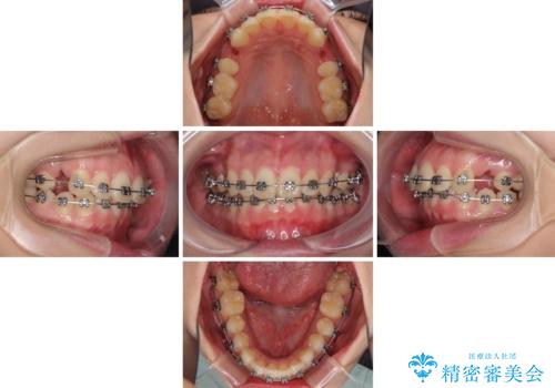 費用を抑えた抜歯矯正　口元の突出感の改善の治療中