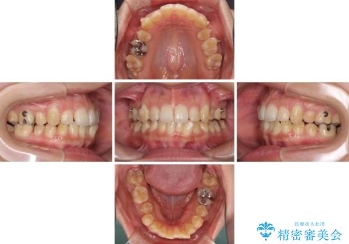 八重歯の抜歯矯正 補助装置を用いたインビザライン矯正の治療中