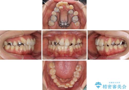 狭い上顎骨を拡大 著しい叢生を抜歯矯正で改善の治療中