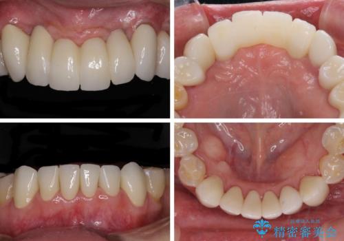 出血が止まらない インプラント補綴を用いた歯周病治療の治療後