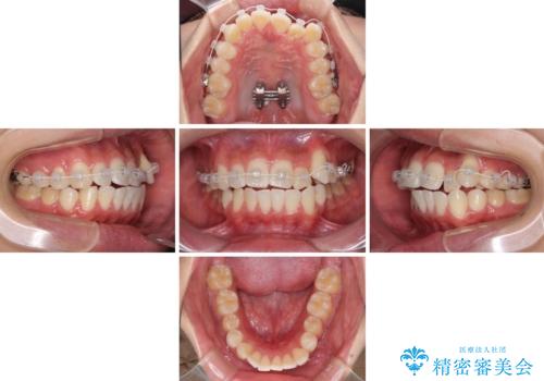 八重歯と奥歯のクロスバイト 上顎骨を拡大してインビザラインで矯正の治療中