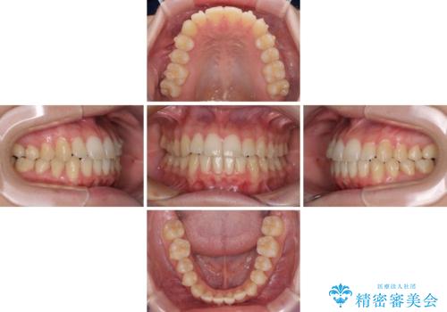 気になる前歯を整えたい インビザライン・ライトでの矯正治療の治療中