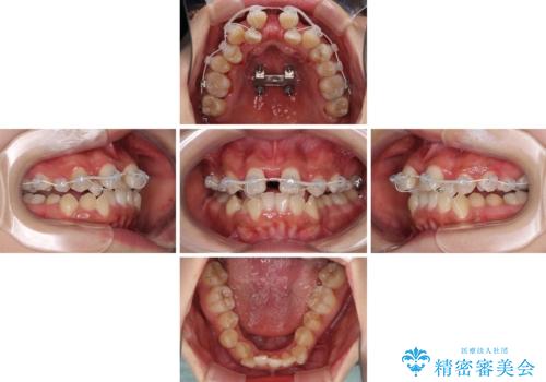 前後に重なった前歯 ワイヤー装置と急速拡大装置を併用したインビザライン矯正の治療中
