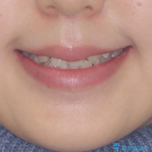 前後に重なった前歯 ワイヤー装置と急速拡大装置を併用したインビザライン矯正の治療前(顔貌)