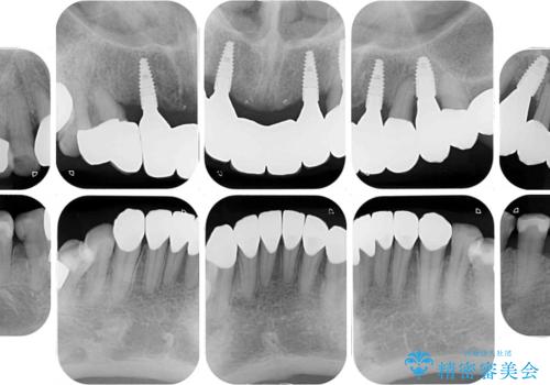 出血が止まらない インプラント補綴を用いた歯周病治療の治療後