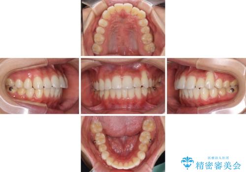 八重歯と奥歯のクロスバイト 上顎骨を拡大してインビザラインで矯正の治療中