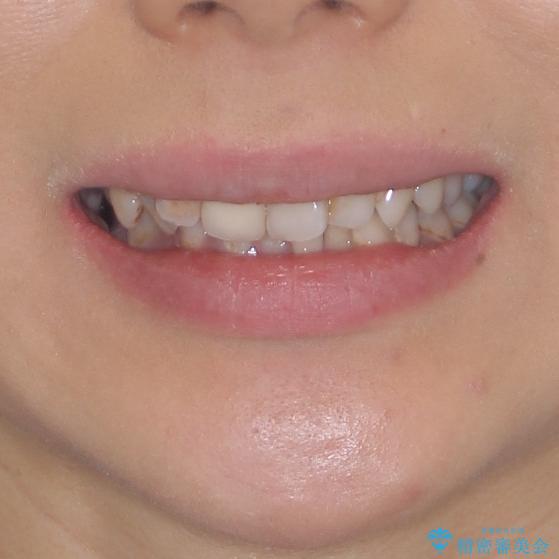 歯並びと目立つ金属を治したい　総合歯科治療の治療前（顔貌）