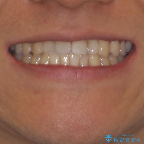 気になる前歯のデコボコをインビザラインで解消の治療前(顔貌)