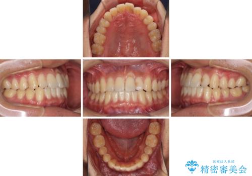 気になる前歯のデコボコをインビザラインで解消の治療中
