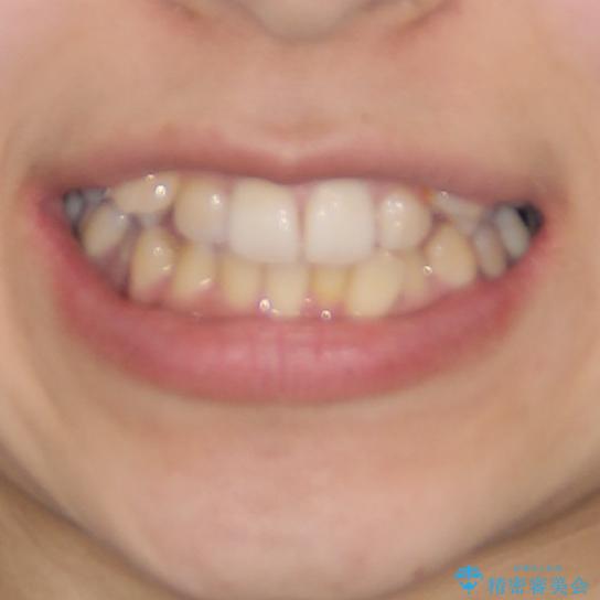 八重歯の抜歯矯正　補助装置を用いたインビザライン矯正の治療前（顔貌）