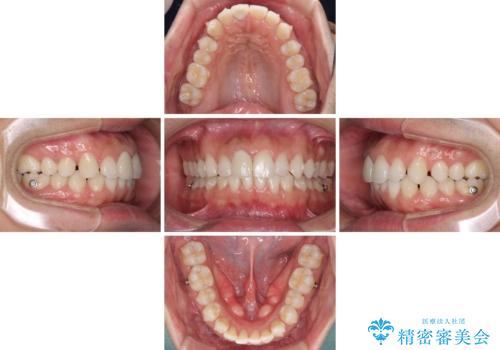 口が閉じにくい インビザラインによる矯正治療の治療中