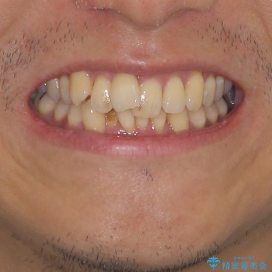 前歯のデコボコ ワイヤー装置での短期間治療の治療前(顔貌)