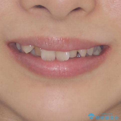 前歯2本が欠損　抜歯矯正でデコボコを治すの治療前（顔貌）