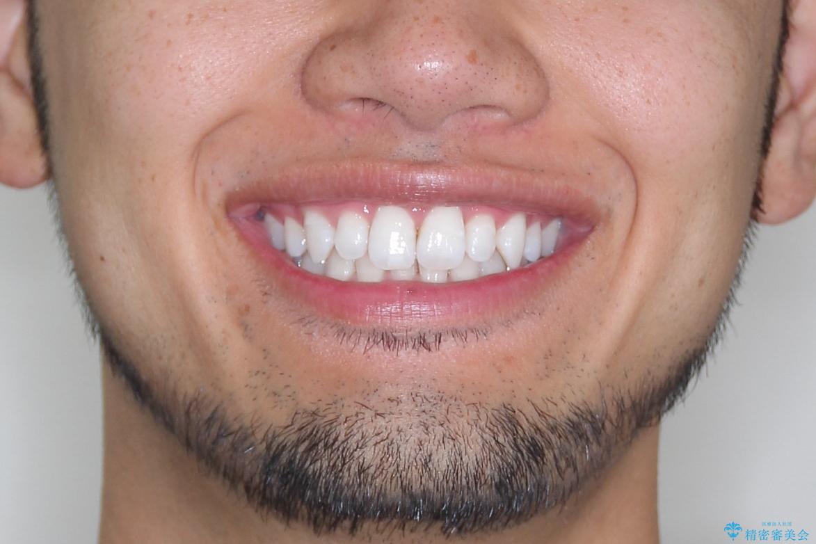 【インビザライン】笑った時の歯並びを綺麗にしたいの治療前(顔貌)