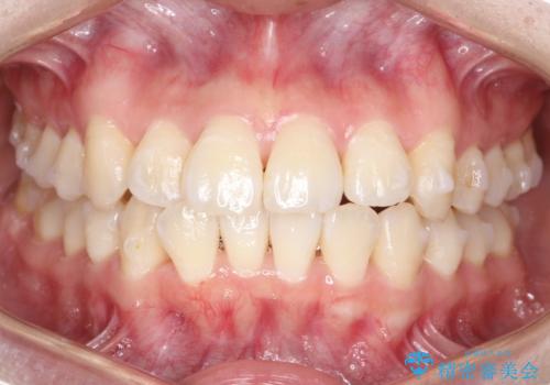 【インビザライン】前歯の凸凹をなおしたいの治療中