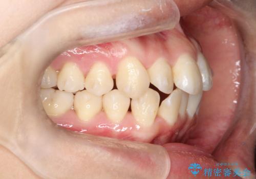 【インビザライン】前歯の凸凹をなおしたいの治療中