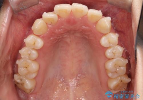 【インビザライン】前歯の凸凹をなおしたいの治療中