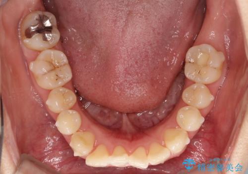 【インビザライン】前歯の凸凹をなおしたいの治療中