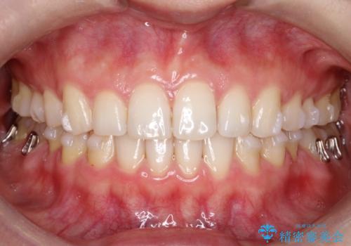 【インビザライン】前歯のガタガタを綺麗にしたい。の治療中