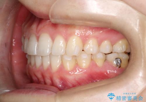 【インビザライン】前歯のガタガタを綺麗にしたい。の治療中