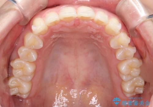 【インビザライン】前歯のガタガタを綺麗にしたい。の治療中