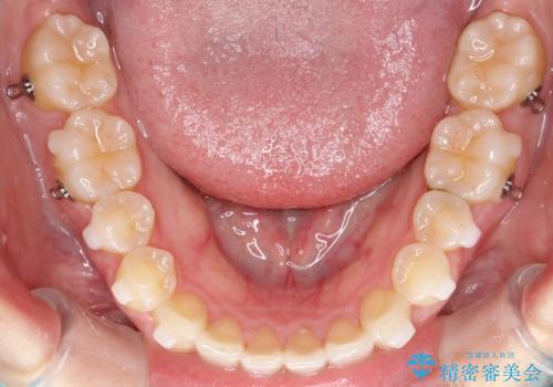 【インビザライン】前歯のガタガタを綺麗にしたい。の治療中