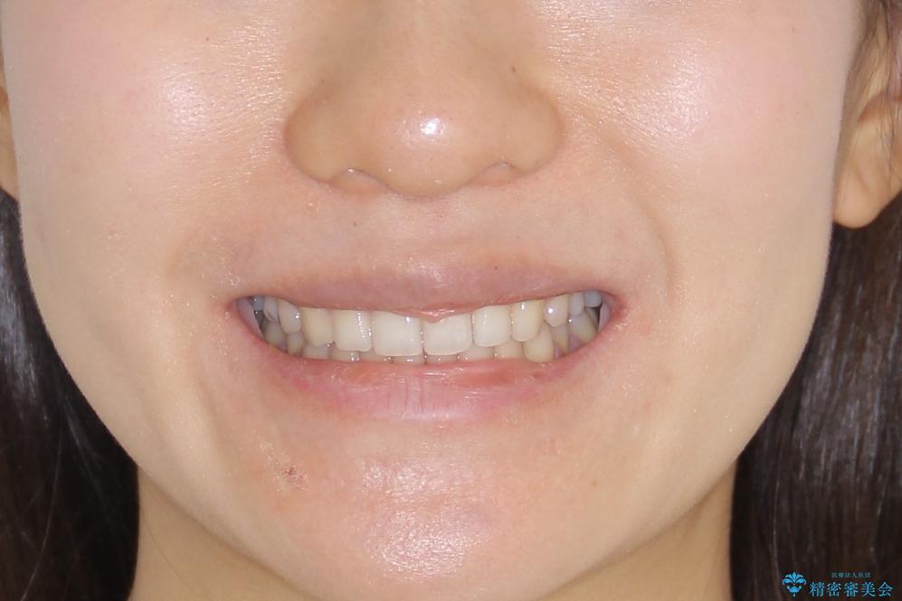 【インビザライン】前歯のガタガタを綺麗にしたい。の治療後(顔貌)