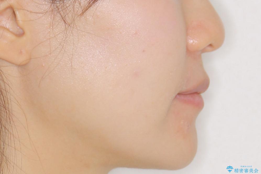 【インビザライン】前歯のガタガタを綺麗にしたい。の治療後(顔貌)