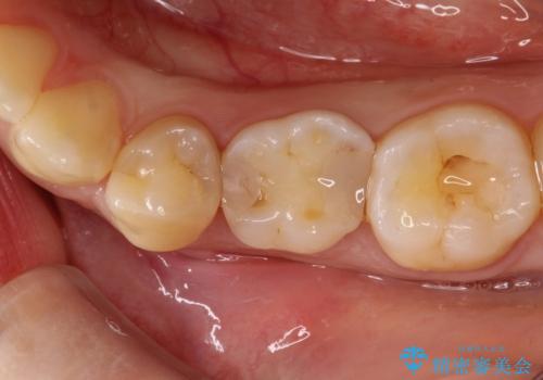 【セラミックインレー】虫歯の治療の治療前