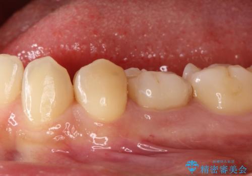 【セラミックインレー】虫歯の治療の治療前