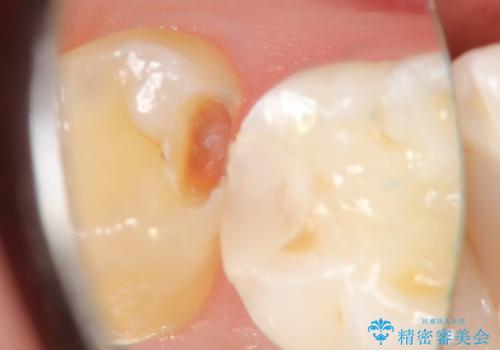 【セラミックインレー】虫歯の治療の治療中