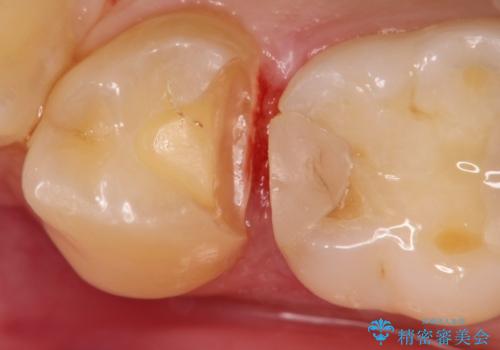 【セラミックインレー】虫歯の治療の治療中
