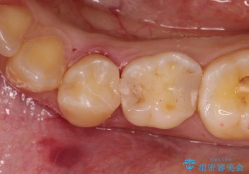 【セラミックインレー】虫歯の治療の治療後