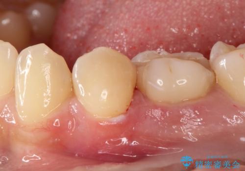 【セラミックインレー】虫歯の治療の治療後