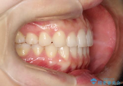 【インビザライン】前歯のガタガタを綺麗にしたい。の治療後