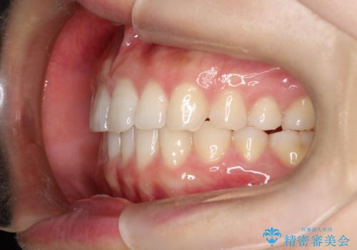 【インビザライン】前歯のガタガタを綺麗にしたい。の治療後