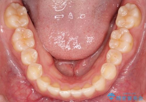 【インビザライン】前歯のガタガタを綺麗にしたい。の治療後