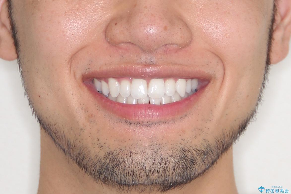 【インビザライン】笑った時の歯並びを綺麗にしたいの治療後(顔貌)