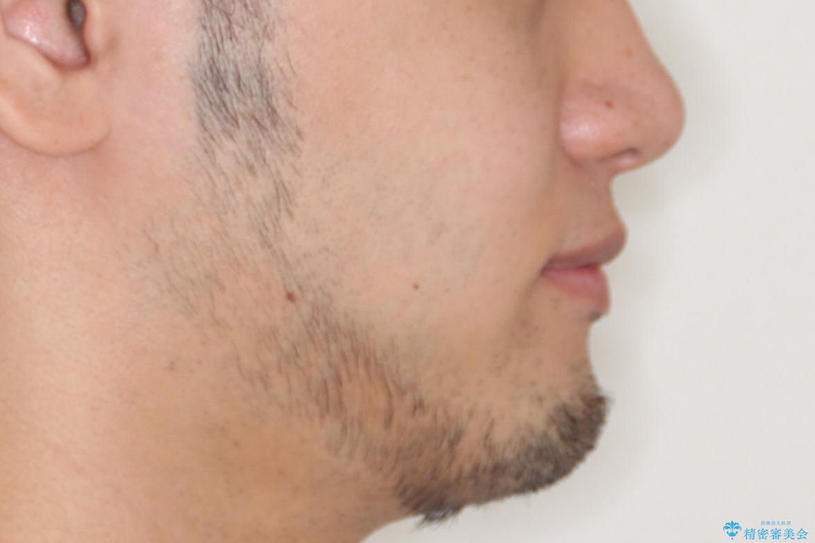 【インビザライン】笑った時の歯並びを綺麗にしたいの治療後(顔貌)