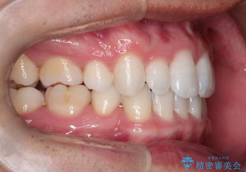 【インビザライン】笑った時の歯並びを綺麗にしたいの治療後